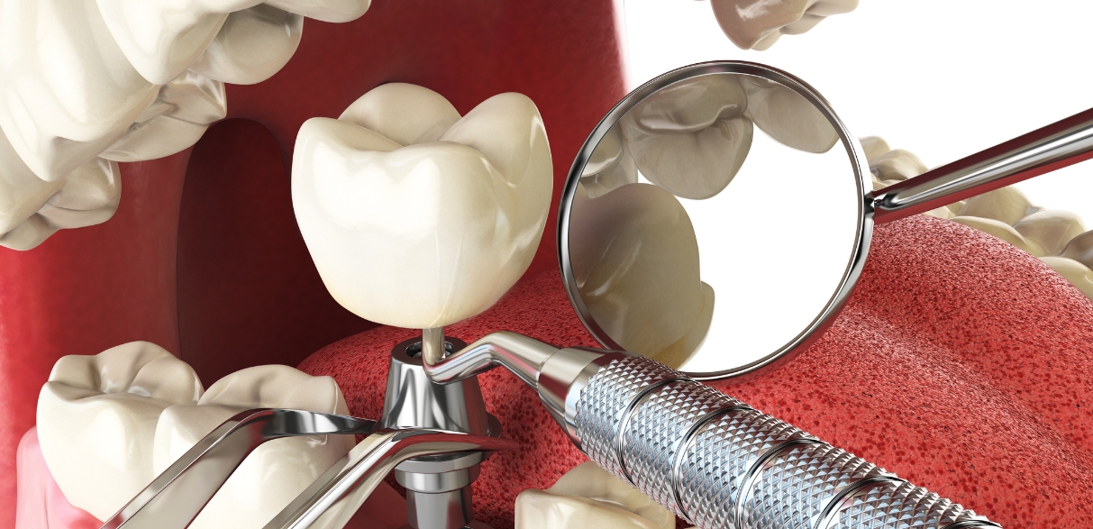 durability of dental implants for oral health