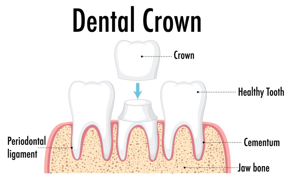 Porcelain Crowns In Mogadore