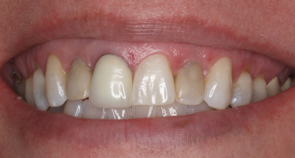 Teeth Cleaning in Mogadore